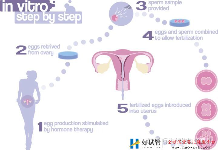 试管婴儿1代、2代、3代、4代哪个最好真实操作过...(图4) 试管婴儿1代、2代、3代、4代哪个最好真实操作过...(图4)